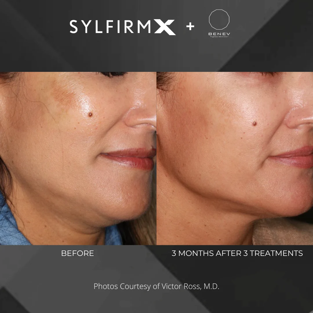 Before and after — melasma improvement three months after three Sylfirm X treatments