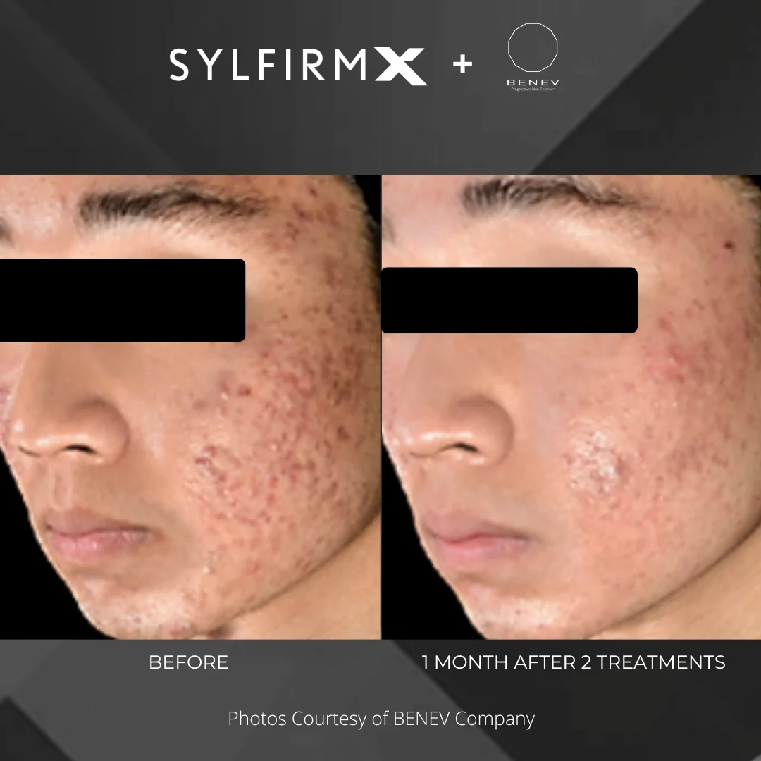 Before and after — texture and tone after two treatments