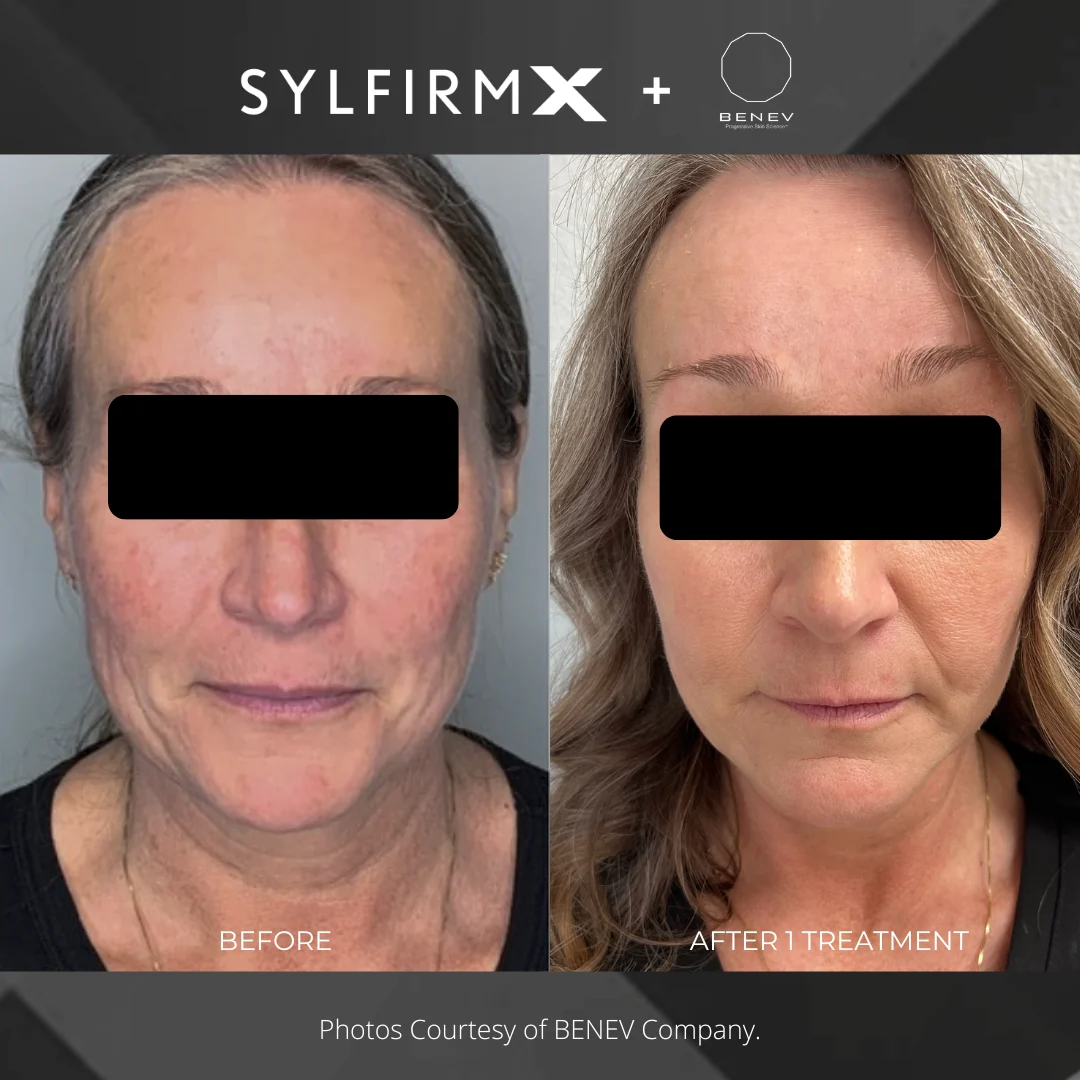 Before and after — facial tightening and tone